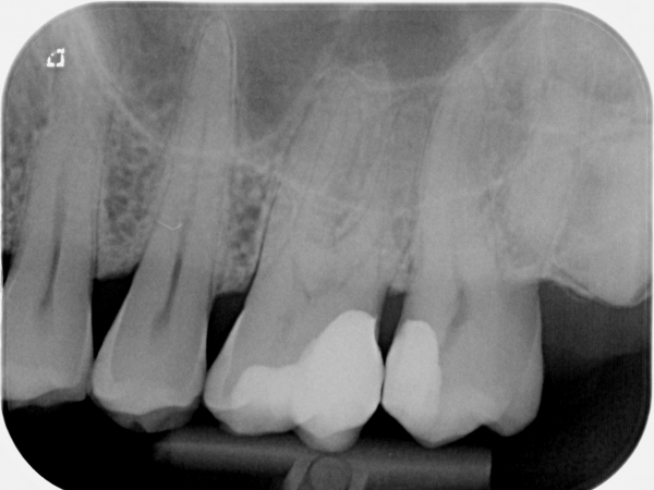 Molar endodontic treatment and its fracture